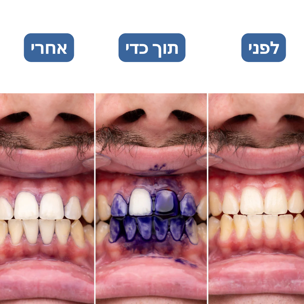 iSmile ערכת ההלבנה של
