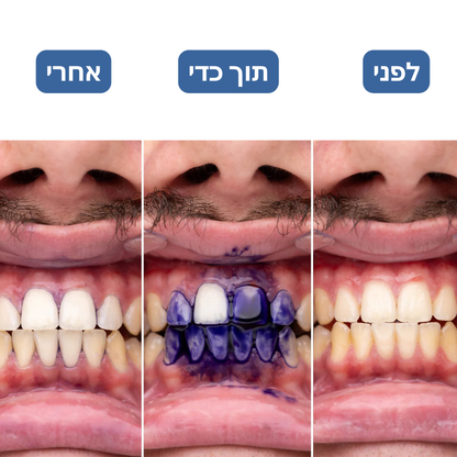 iSmile ערכת ההלבנה של